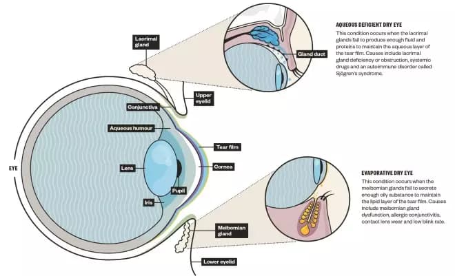 Understanding Dry Eye